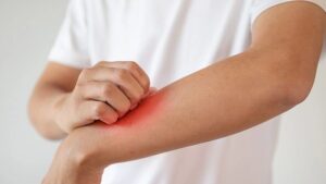 Yerköy Devlet Hastanesi Başhekimi Uzman Dr. Ali Demir, mantar hastalıklarının