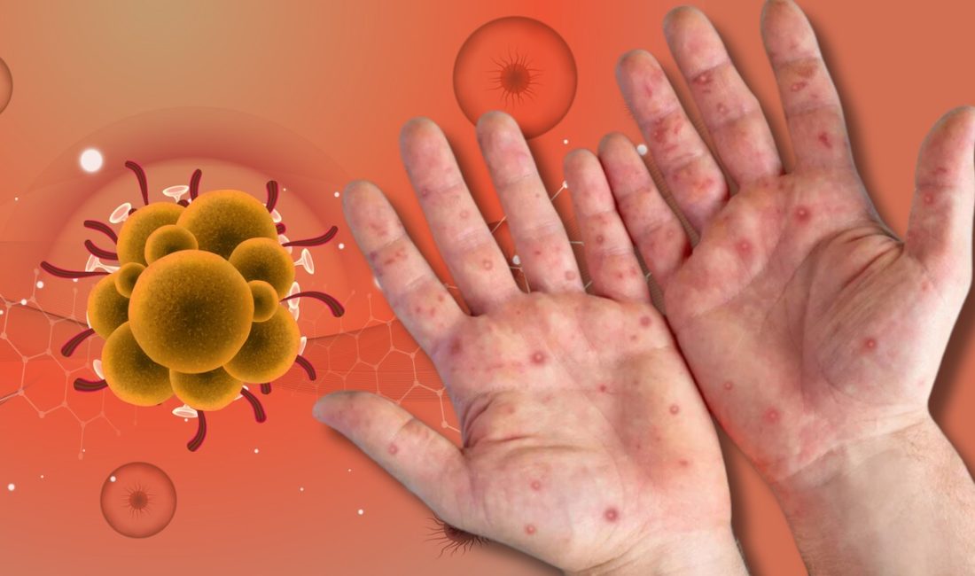 Prof. Dr. Demirer’den, Maymun Çiçeği hastalığına karşı kritik uyarı Prof. Dr. Taner Demirer'den Sağlık Bakanlığına Kritik Uyarı: "Afrikalı Öğrencilerin