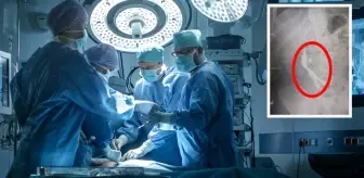 Kayseri’de mide ağrısı şikayetiyle hastaneye başvuran çocuğun midesinden 4 metal