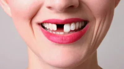 Rüya Tabirleri, Rüyada Dişlerin Düştüğünü Görmek Ne Anlama Gelir? İşte Detaylı Anlamı İmam-ı Nablusi’nin yorumu: Kişinin rüyada dişlerinin düştüğünü görmesi, kendi akranlarından