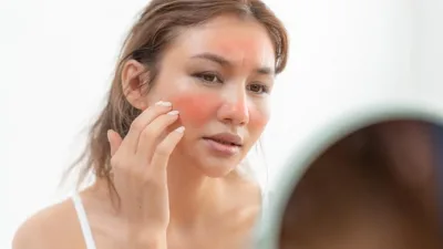 Cildimizde sıkça karşılaşılan et benleri, genellikle zararsız olmakla birlikte estetik