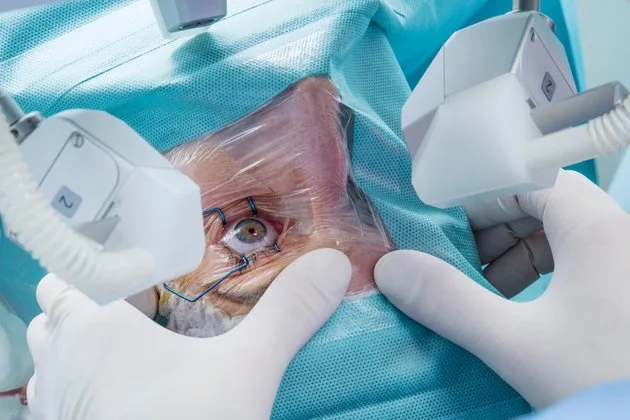 Göz çizdirme ameliyatı, kırma kusurlarını düzeltmeye yönelik cerrahi bir işlem