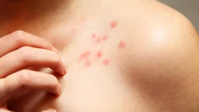 Kist hidatik, hayvanlardan insanlara bulaşabilen paraziter bir hastalıktır. Echinococcus granulosus