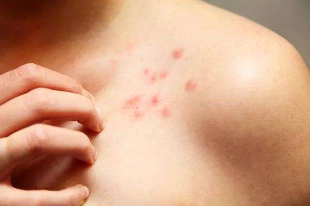 Kist hidatik, hayvanlardan insanlara bulaşabilen paraziter bir hastalıktır. Echinococcus granulosus