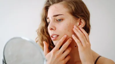 Kistik sivilce, cilt altında derin, iltihaplı ve ağrılı nodüller halinde