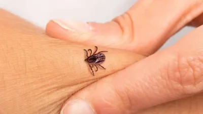 Sivas’ta vücuduna yapışan üç keneyi yanlış yöntemle çıkarmaya çalışan kişi,