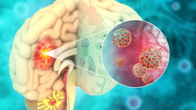 Beyin tümörü, beynin kendi dokusunda yer alan hücrelerin kontrolsüz bir