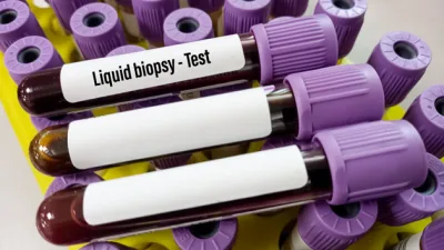 Likit biyopsi, kanser hastalığının tanı ve tedavi süreçlerinde kullanılan önemli