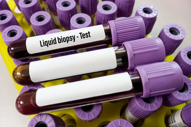 Likit biyopsi, kanser hastalığının tanı ve tedavi süreçlerinde kullanılan önemli