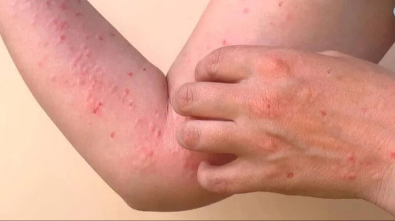 Çin'in Foşan kentinde sivrisinek kaynaklı Chikungunya virüsü binlerce kişiye bulaştı.