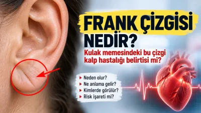 Frank çizgisi nedir, neden olur ve kalp hastalığı belirtisi midir?
